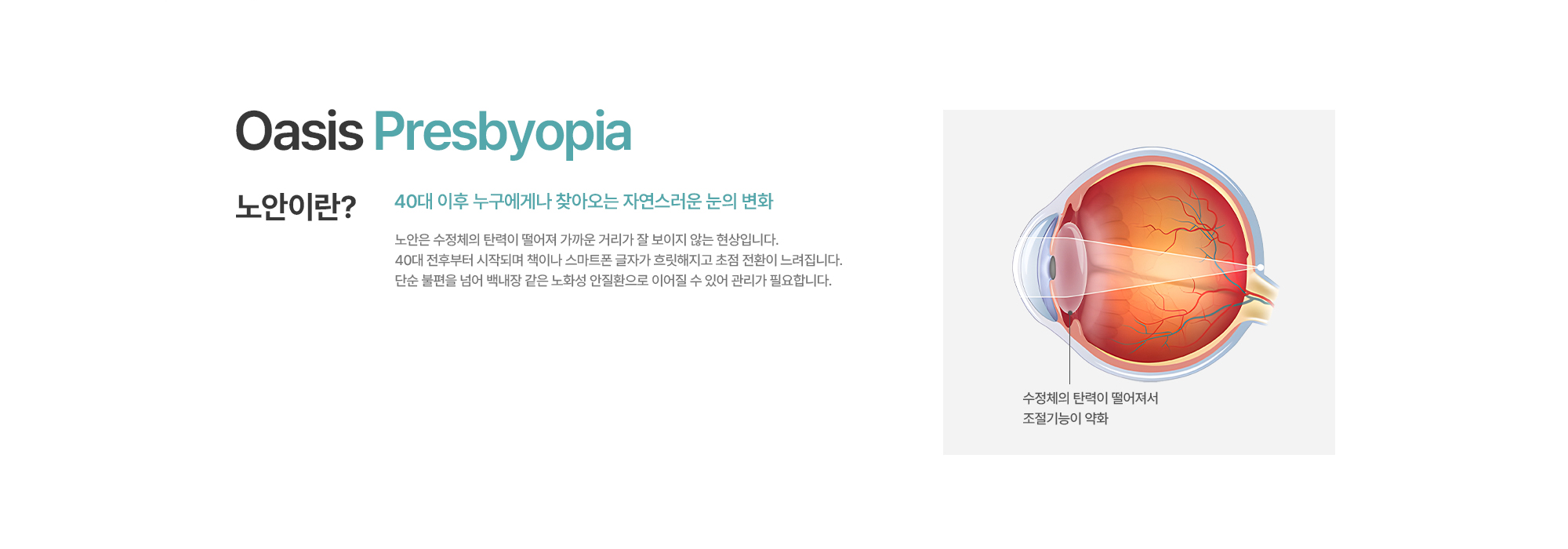 [노안이란?] 40대 이후 누구에게나 찾아오는 자연스러운 눈의 변화. 노안은 수정체의 탄력이 떨어져 가까운 거리가 잘 보이지 않는 현상입니다. 40대 전후부터 시작되며 책이나 스마트폰 글자가 흐릿해지고 초점 전환이 느려집니다. 단순 불편을 넘어 백내장 같은 노화성 안질환으로 이어질 수 있어 관리가 필요합니다.