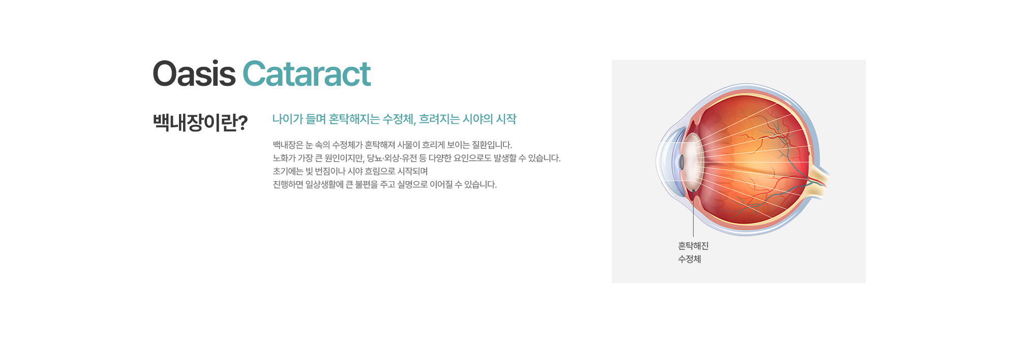 [백내장이란?] 나이가 들며 혼탁해지는 수정체, 흐려지는 시야의 시작. 백내장은 눈 속의 수정체가 혼탁해져 사물이 흐리게 보이는 질환입니다. 노화가 가장 큰 원인이지만, 당뇨·외상·유전 등 다양한 요인으로도 발생할 수 있습니다. 초기에는 빛 번짐이나 시야 흐림으로 시작되며 진행하면 일상생활에 큰 불편을 주고 실명으로 이어질 수 있습니다.