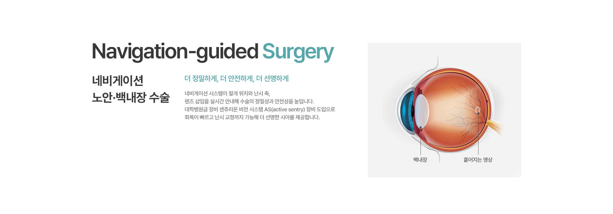 [네비게이션 노안·백내장 수술] 더 정밀하게, 더 안전하게, 더 선명하게. 네비게이션 시스템이 절개 위치와 난시 축, 렌즈 삽입을 실시간 안내해 수술의 정밀성과 안전성을 높입니다. 다산 최초 센츄리온 비전 시스템 AS(active sentry) 장비 도입으로 회복이 빠르고 난시 교정까지 가능해 더 선명한 시야를 제공합니다.