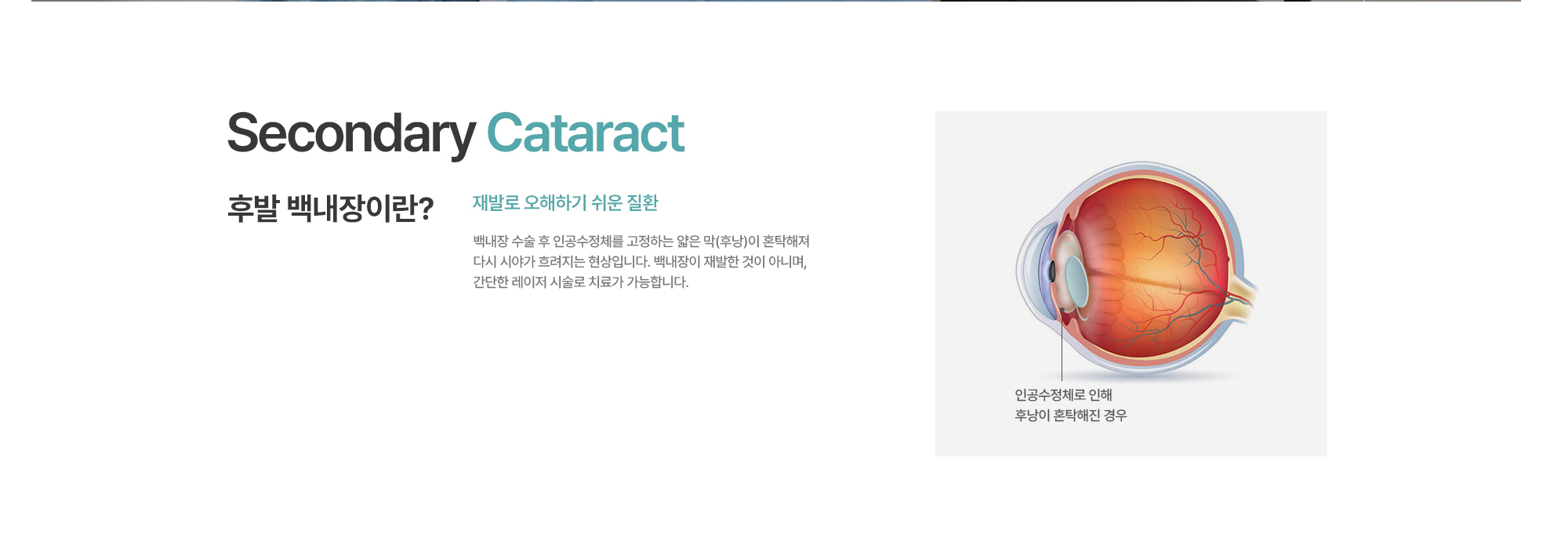 [후발 백내장이란?] 재발로 오해하기 쉬운 질환. 백내장 수술 후 인공수정체를 고정하는 얇은 막(후낭)이 혼탁해져 다시 시야가 흐려지는 현상입니다. 백내장이 재발한 것이 아니며, 전체 환자의 약 20~30%에서 나타날 수 있습니다. 간단한 레이저 시술로 치료가 가능합니다.