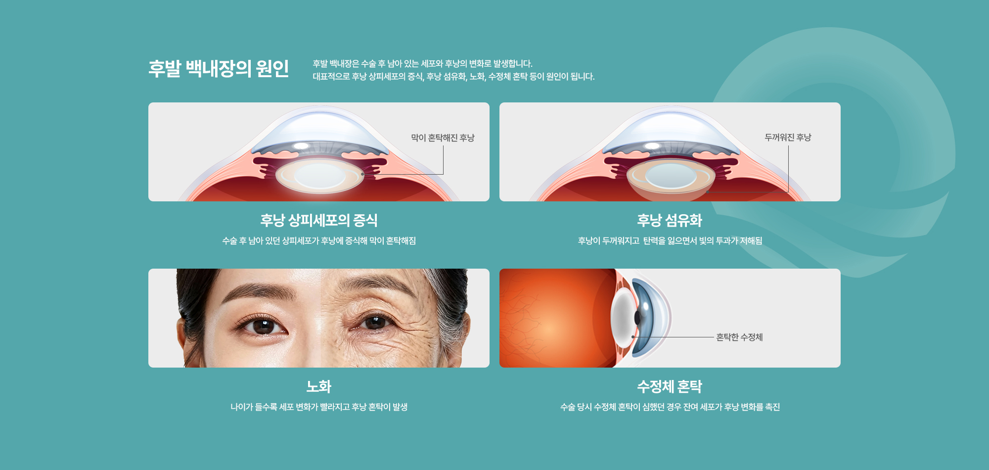 [후발 백내장의 원인] 후발 백내장은 수술 후 남아 있는 세포와 후낭의 변화로 발생합니다. 대표적으로 후낭 상피세포의 증식, 후낭 섬유화, 노화, 수정체 혼탁 등이 원인이 됩니다.