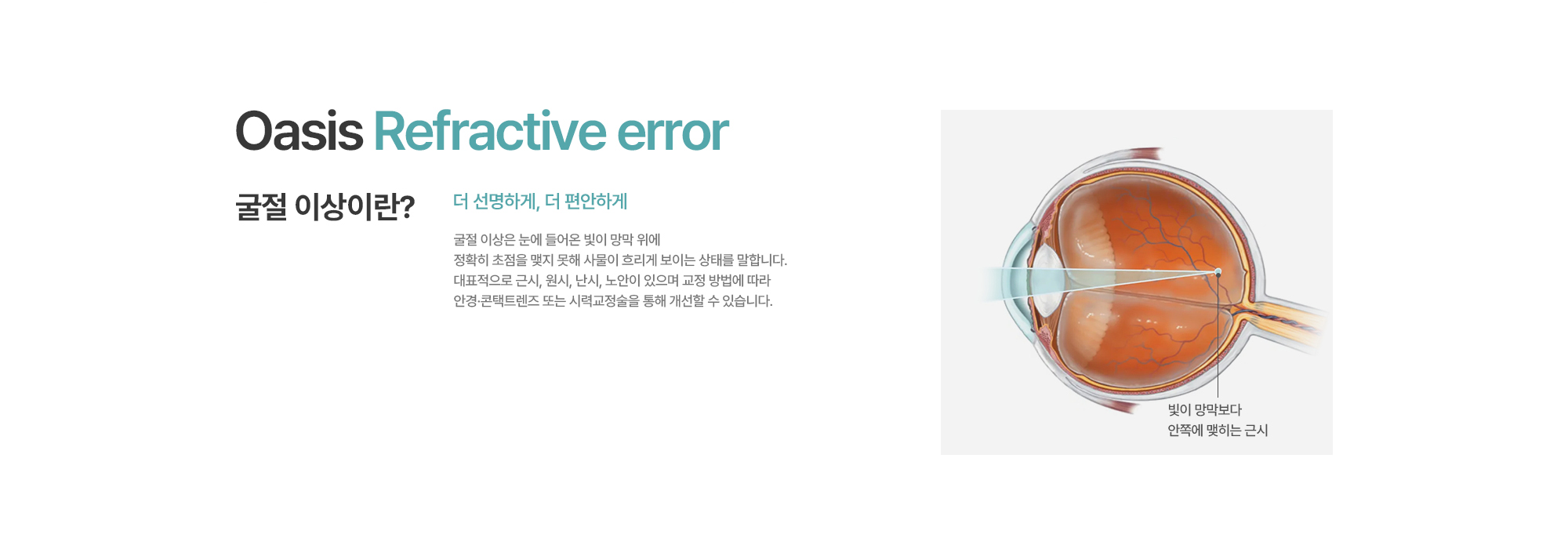 [굴절 이상이란?] 더 선명하게, 더 편안하게. 굴절 이상은 눈에 들어온 빛이 망막 위에 정확히 초점을 맺지 못해 사물이 흐리게 보이는 상태를 말합니다. 대표적으로 근시, 원시, 난시, 노안이 있으며 교정 방법에 따라 안경·콘택트렌즈 또는 시력교정술을 통해 개선할 수 있습니다.