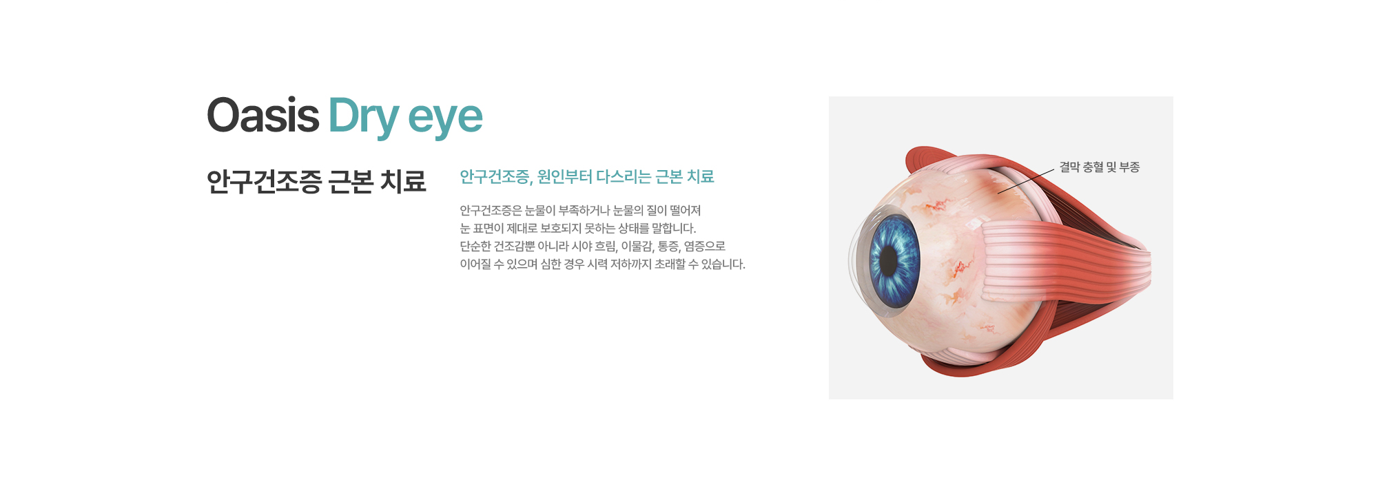 [안구건조증 근본 치료] 안구건조증, 원인부터 다스리는 근본 치료. 안구건조증은 눈물이 부족하거나 눈물의 질이 떨어져 눈 표면이 제대로 보호되지 못하는 상태를 말합니다. 단순한 건조감뿐 아니라 시야 흐림, 이물감, 통증, 염증으로 이어질 수 있으며 심한 경우 시력 저하까지 초래할 수 있습니다.