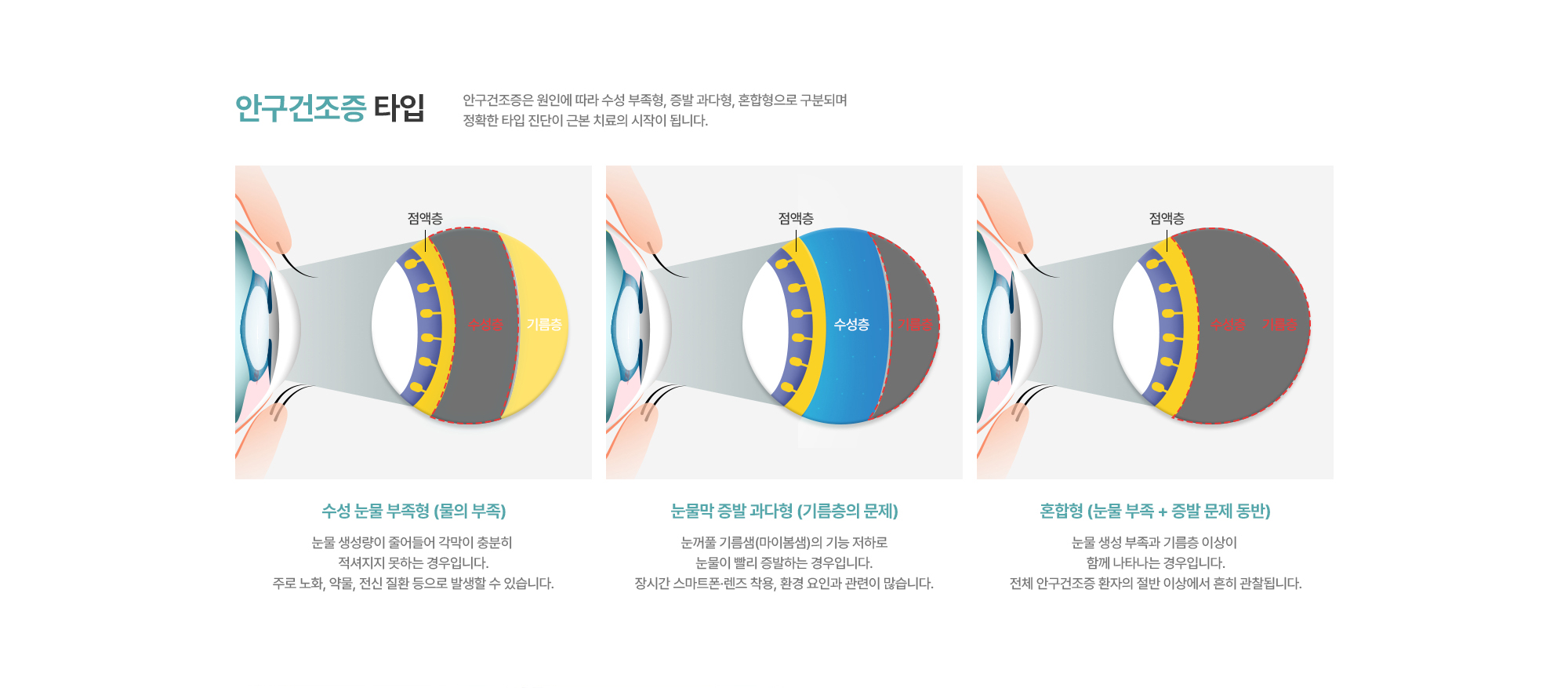 [안구건조증 타입] 수성 눈물 부족형 (물의 부족) / 눈물막 증발 과다형 (기름층의 문제) / 혼합형 (눈물 부족 + 증발 문제 동반)