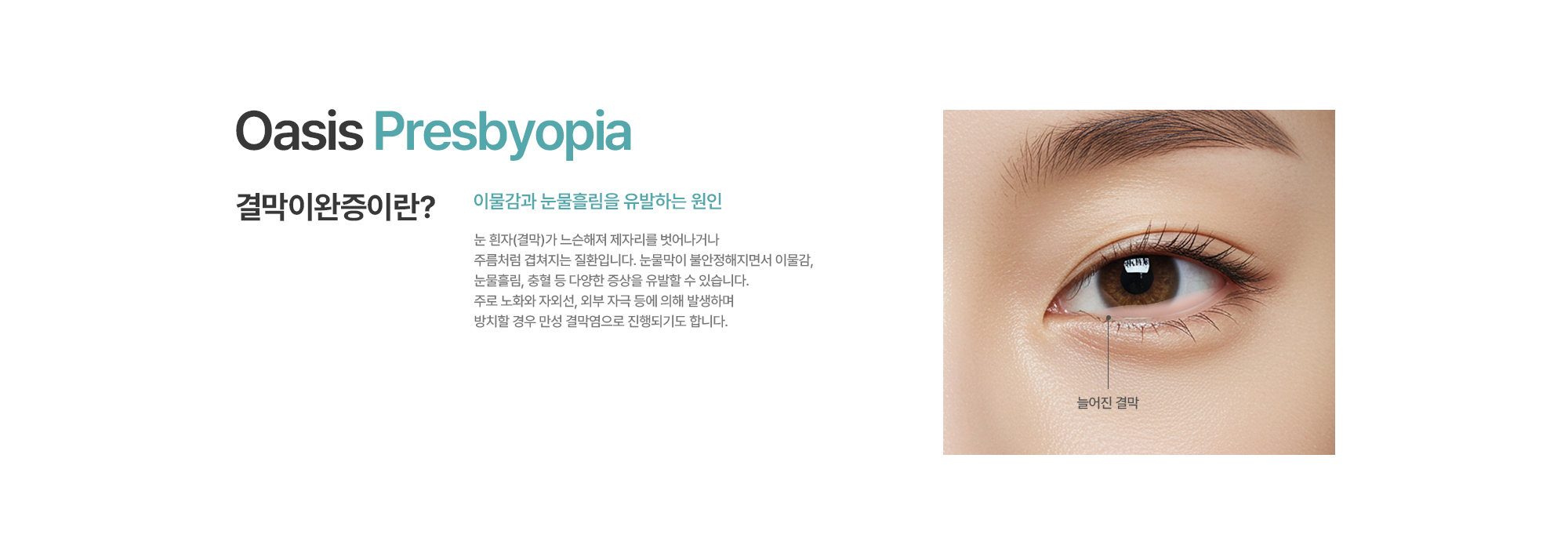 [결막이완증이란?] 이물감과 눈물흘림을 유발하는 원인. 눈 흰자(결막)가 느슨해져 제자리를 벗어나거나 주름처럼 겹쳐지는 질환입니다. 눈물막이 불안정해지면서 이물감, 눈물흘림, 충혈 등 다양한 증상을 유발할 수 있습니다. 주로 노화와 자외선, 외부 자극 등에 의해 발생하며 방치할 경우 만성 결막염으로 진행되기도 합니다.