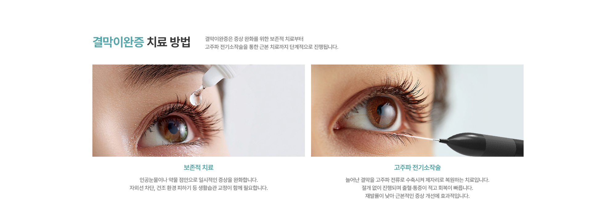 [결막이완증 치료 방법] 결막이완증은 증상 완화를 위한 보존적 치료부터 고주파 전기소작술을 통한 근본 치료까지 단계적으로 진행됩니다.