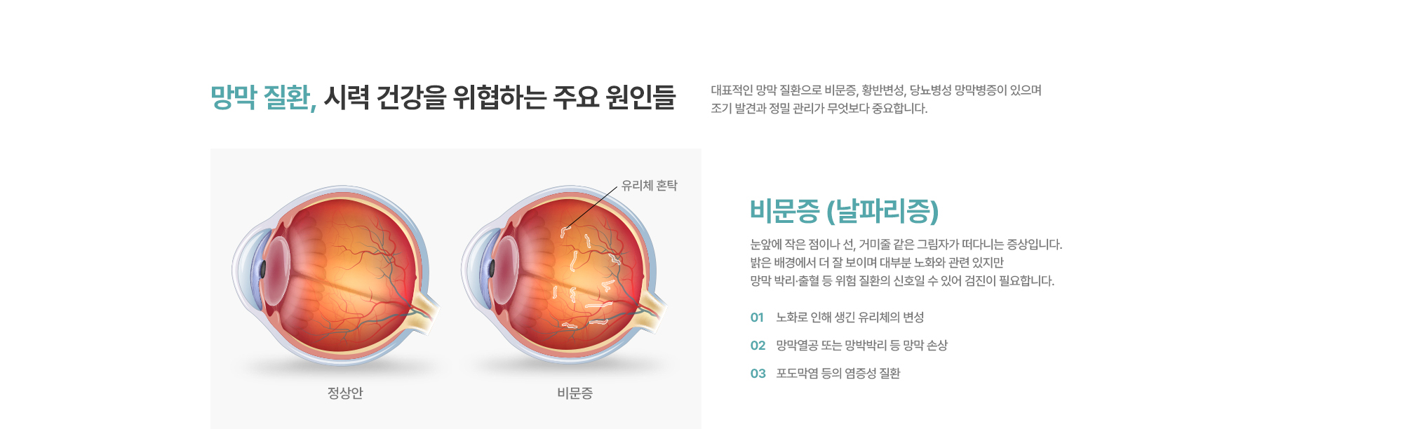 [비문증 (날파리증)] 눈앞에 작은 점이나 선, 거미줄 같은 그림자가 떠다니는 증상입니다. 밝은 배경에서 더 잘 보이며 대부분 노화와 관련 있지만 망막 박리·출혈 등 위험 질환의 신호일 수 있어 검진이 필요합니다.