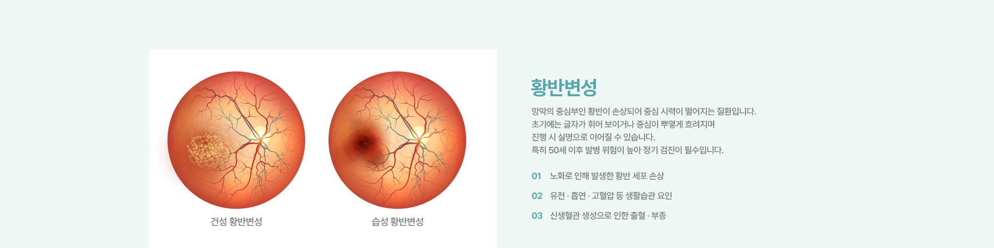 [황반변성] 망막의 중심부인 황반이 손상되어 중심 시력이 떨어지는 질환입니다. 초기에는 글자가 휘어 보이거나 중심이 뿌옇게 흐려지며 진행 시 실명으로 이어질 수 있습니다. 특히 50세 이후 발병 위험이 높아 정기 검진이 필수입니다.