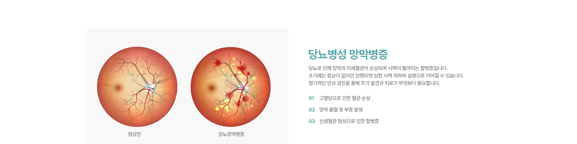 [당뇨병성 망막병증] 당뇨로 인해 망막의 미세혈관이 손상되며 시력이 떨어지는 합병증입니다. 초기에는 증상이 없지만 진행되면 심한 시력 저하와 실명으로 이어질 수 있습니다. 정기적인 안과 검진을 통해 조기 발견과 치료가 무엇보다 중요합니다.