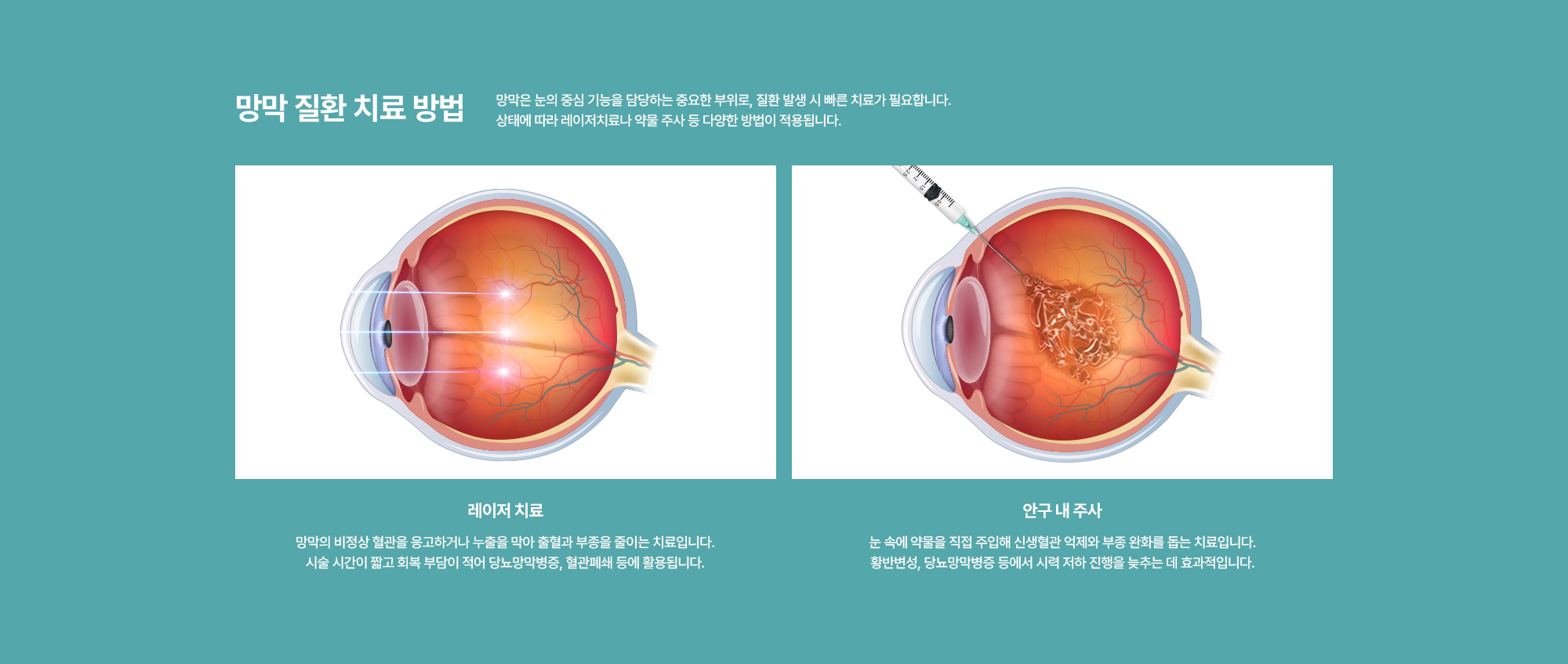 [망막 질환 치료 방법] 레이저 치료 / 안구 내 주사