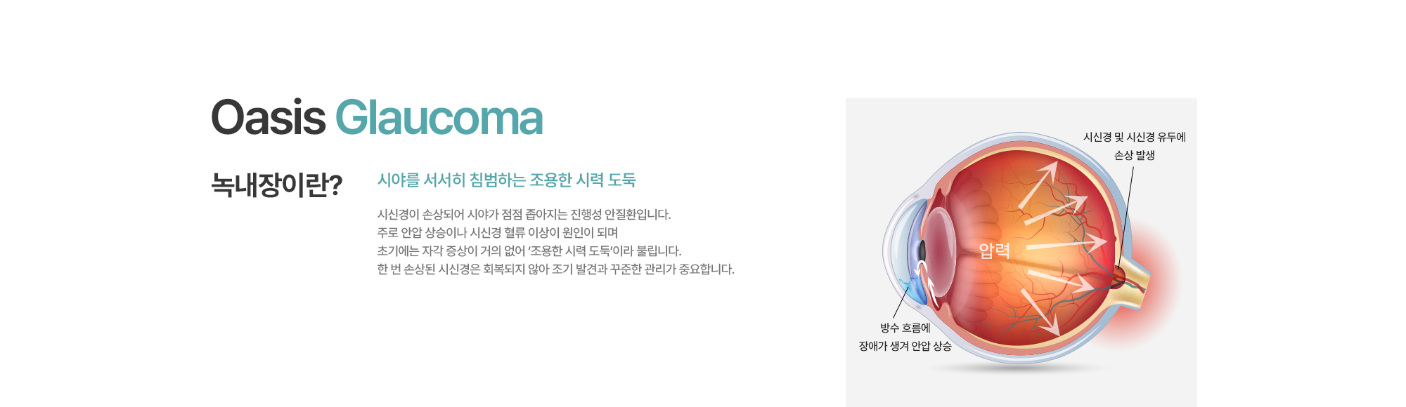 [녹내장이란?] 시야를 서서히 침범하는 조용한 시력 도둑. 시신경이 손상되어 시야가 점점 좁아지는 진행성 안질환입니다. 주로 안압 상승이나 시신경 혈류 이상이 원인이 되며 초기에는 자각 증상이 거의 없어 ‘조용한 시력 도둑’이라 불립니다. 한 번 손상된 시신경은 회복되지 않아 조기 발견과 꾸준한 관리가 중요합니다.