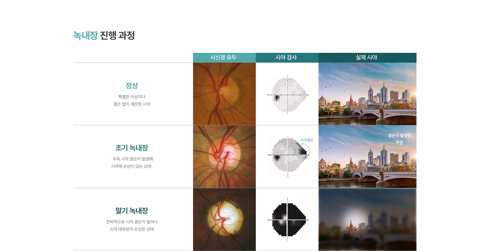 [녹내장 진행 과정] 초기 녹내장 : 우측 시야 결손이 발생해 시야에 손상이 있는 상태 > 말기 녹내장 : 전박적으로 시야 결손이 일어나 시야 대부분이 손상된 상태 