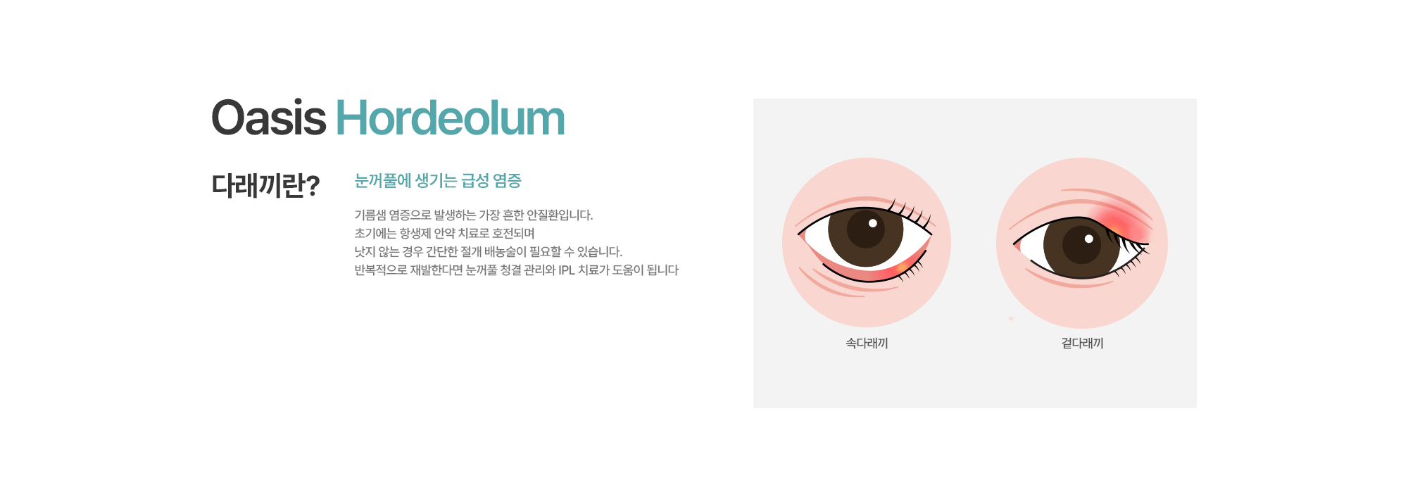 [다래끼란?] 기름샘 염증으로 발생하는 가장 흔한 안질환입니다. 초기에는 항생제 안약 치료로 호전되며 낫지 않는 경우 간단한 절개 배농술이 필요할 수 있습니다. 반복적으로 재발한다면 눈꺼풀 청결 관리와 IPL 치료가 도움이 됩니다.