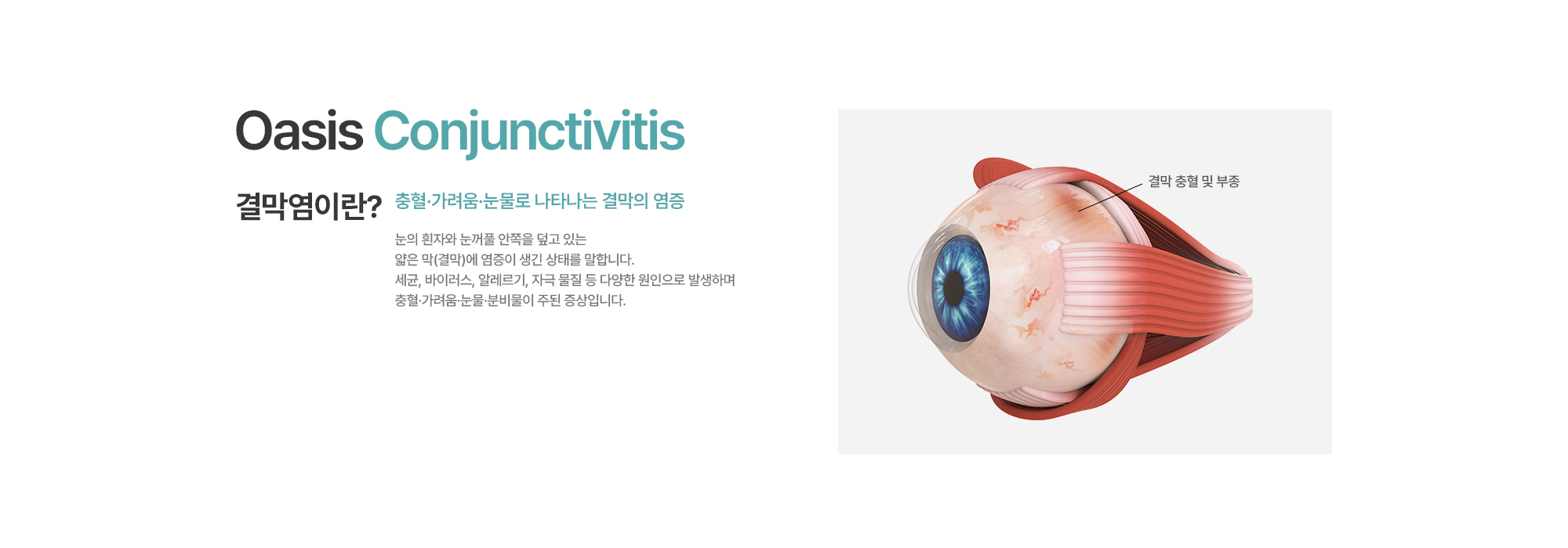 [결막염이란?] 눈의 흰자와 눈꺼풀 안쪽을 덮고 있는 얇은 막(결막)에 염증이 생긴 상태를 말합니다. 세균, 바이러스, 알레르기, 자극 물질 등 다양한 원인으로 발생하며 충혈·가려움·눈물·분비물이 주된 증상입니다.