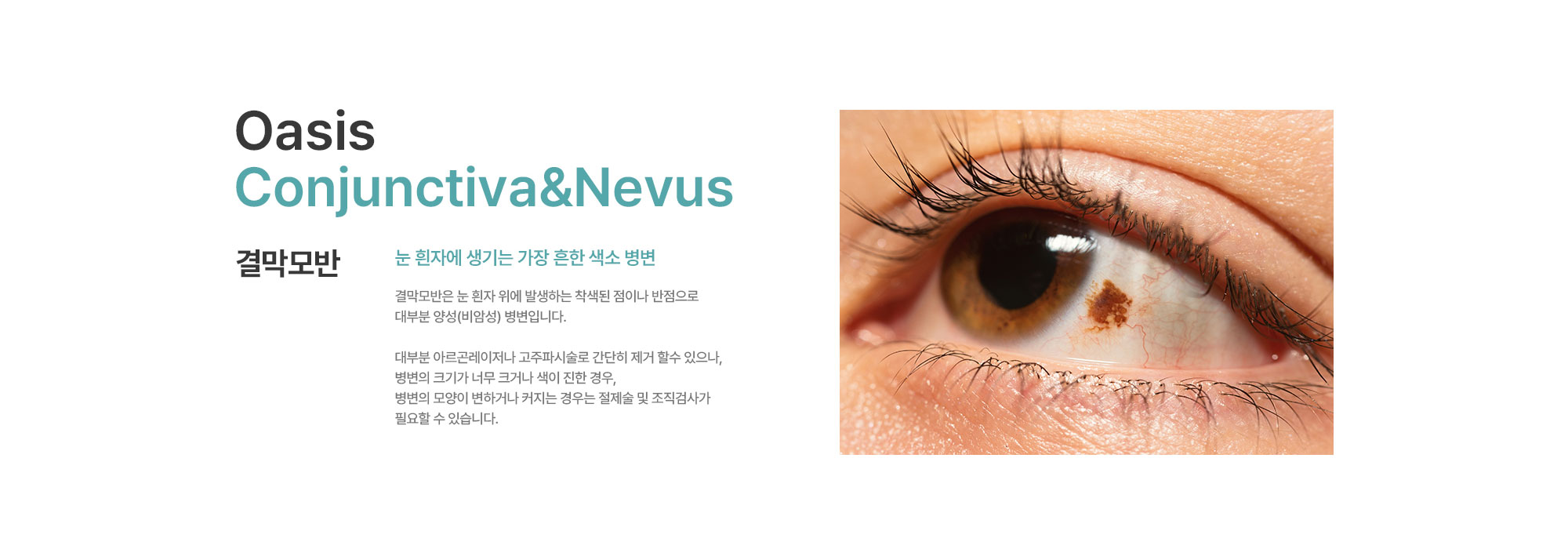 [결막모반] 결막모반은 눈 흰자 위에 발생하는 착색된 점이나 반점으로 대부분 양성(비암성) 병변입니다. 소아나 청소년기에 잘 나타나며 색이 갈색, 회색, 흑갈색 등으로 보일 수 있습니다. 눈 흰자에 생기는 색소 덩어리로 모양이 변하거나 커지는 경우 아르곤레이저나 절제술로 치료할 수 있습니다.
