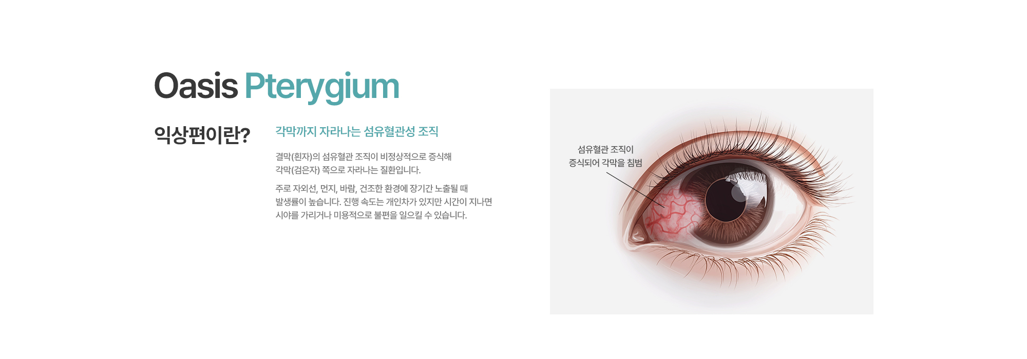 [익상편이란?] 결막(흰자)의 섬유혈관 조직이 비정상적으로 증식해 각막(검은자) 쪽으로 자라나는 질환입니다. 주로 자외선, 먼지, 바람, 건조한 환경에 장기간 노출될 때 발생률이 높습니다. 진행 속도는 개인차가 있지만 시간이 지나면 시야를 가리거나 미용적으로 불편을 일으킬 수 있습니다.