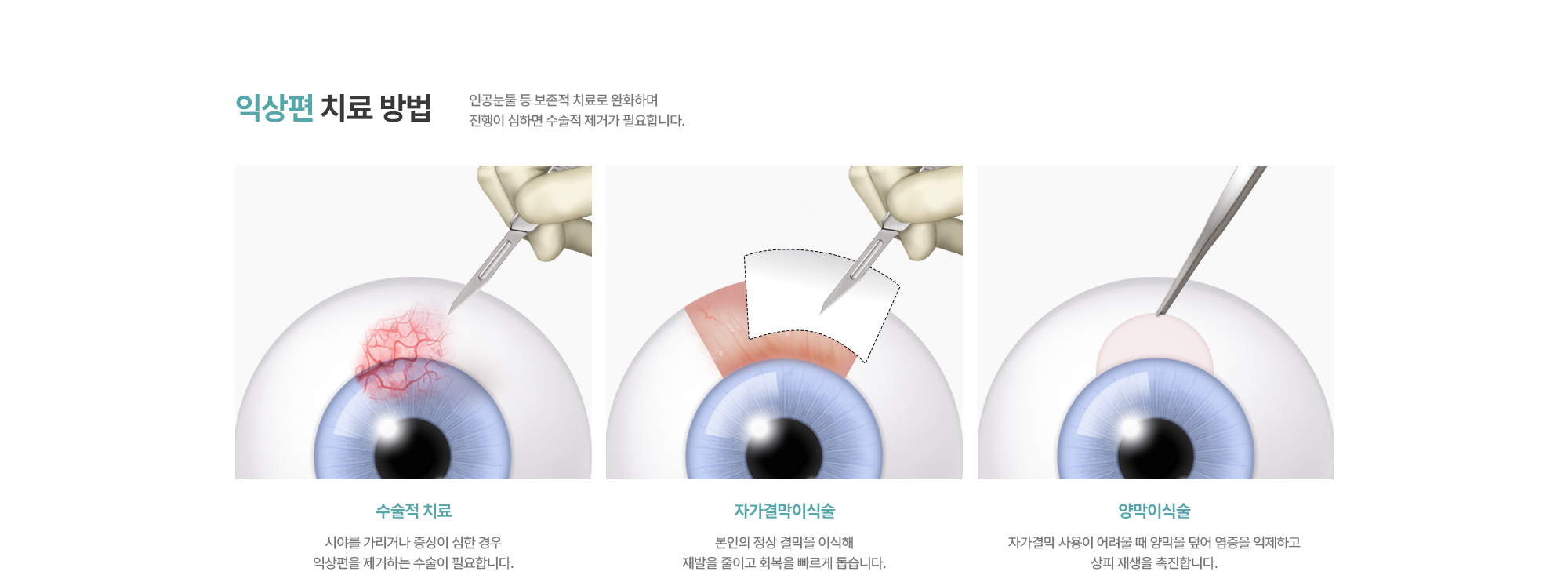 [익상편 치료 방법] 수술적 치료 / 자가결막이식술 / 양막이식술