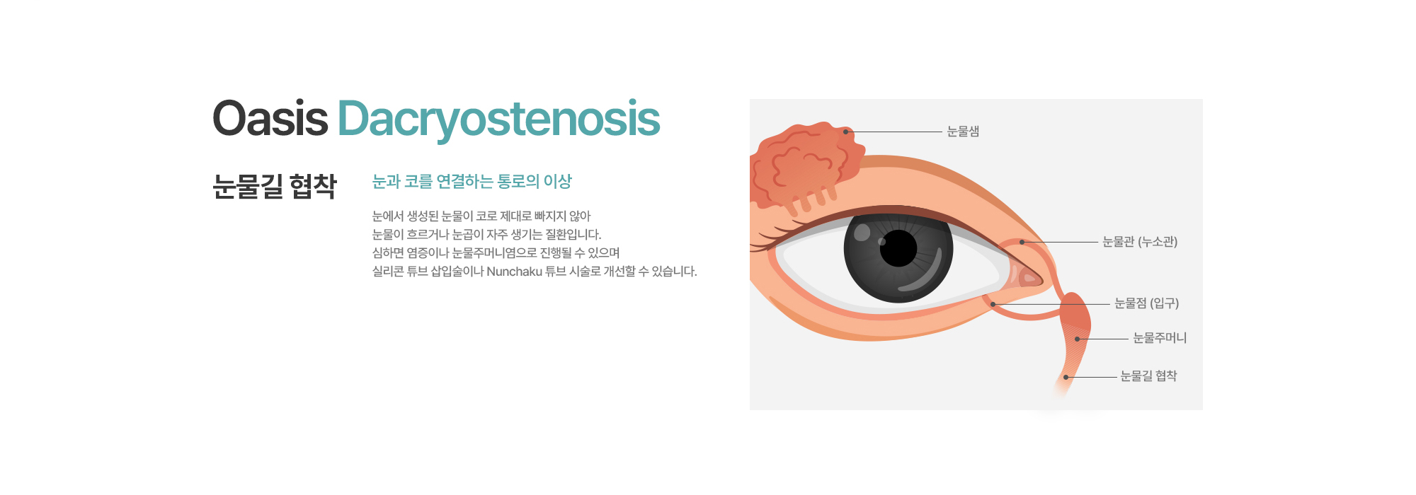 [눈물길 협착] 눈에서 생성된 눈물이 코로 제대로 빠지지 않아 눈물이 흐르거나 눈곱이 자주 생기는 질환입니다. 심하면 염증이나 눈물주머니염으로 진행될 수 있으며 실리콘 튜브 삽입술이나 Nunchaku 튜브 시술로 개선할 수 있습니다.